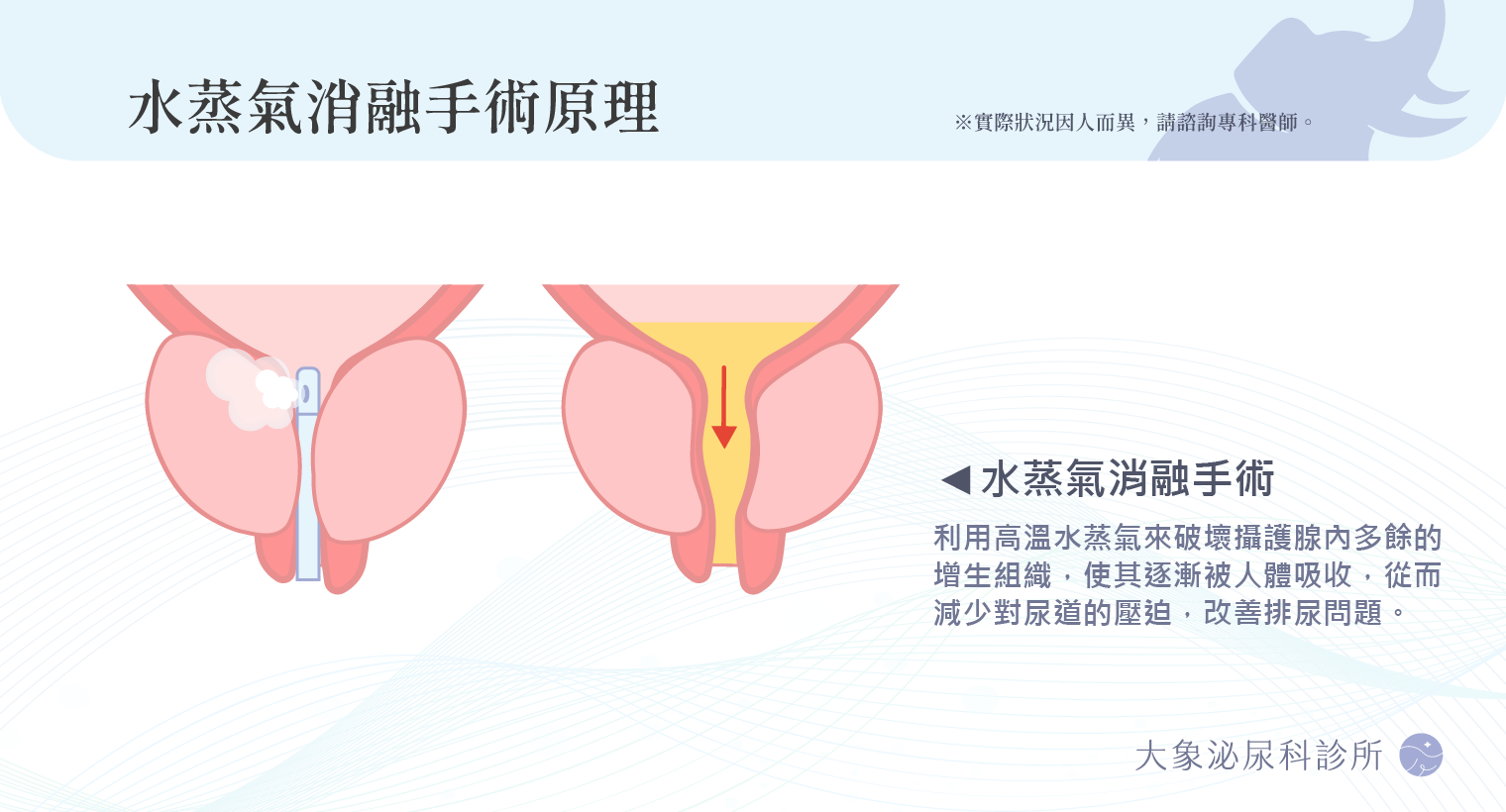 攝護腺微創手術