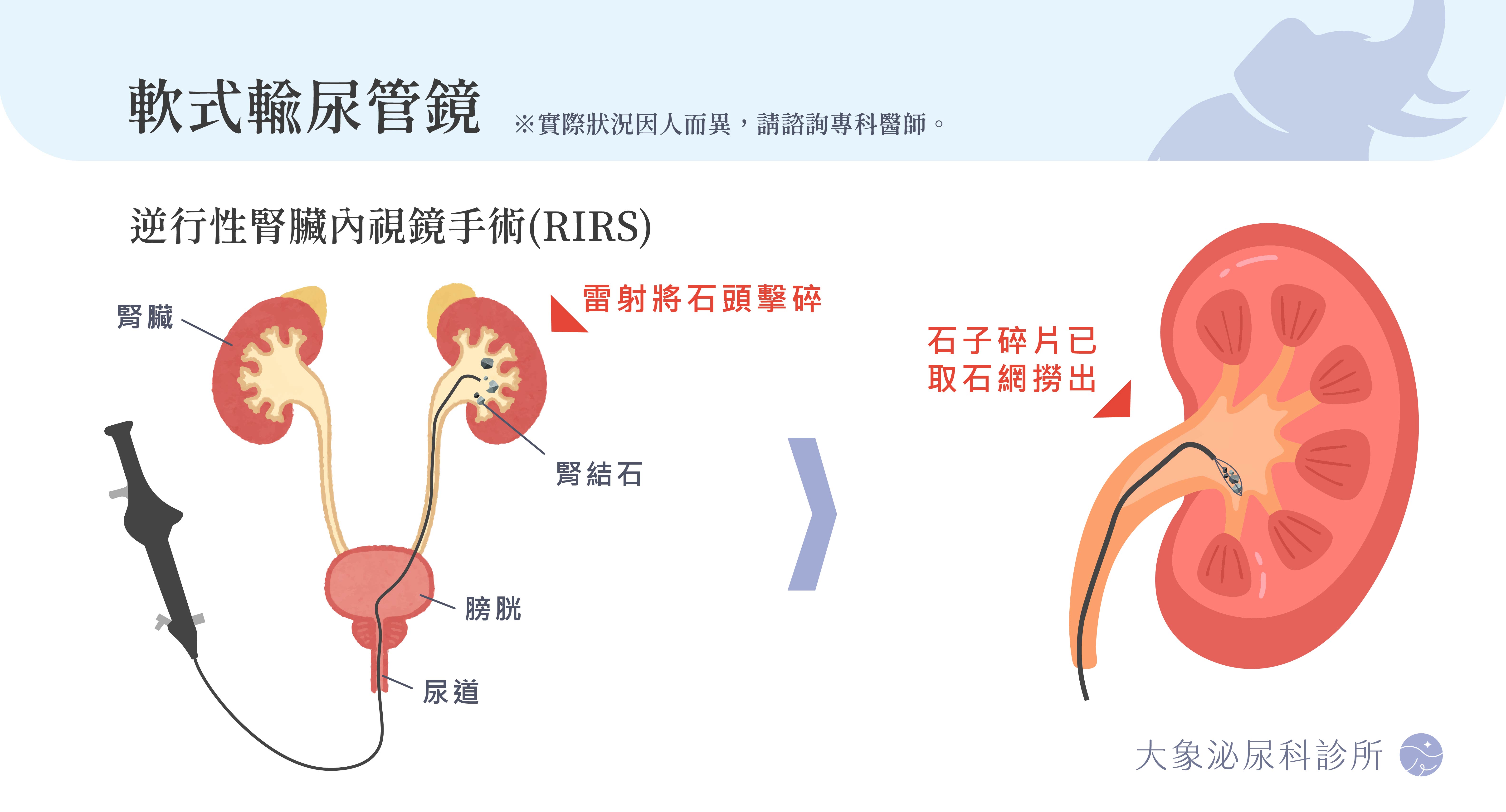 軟式輸尿管鏡