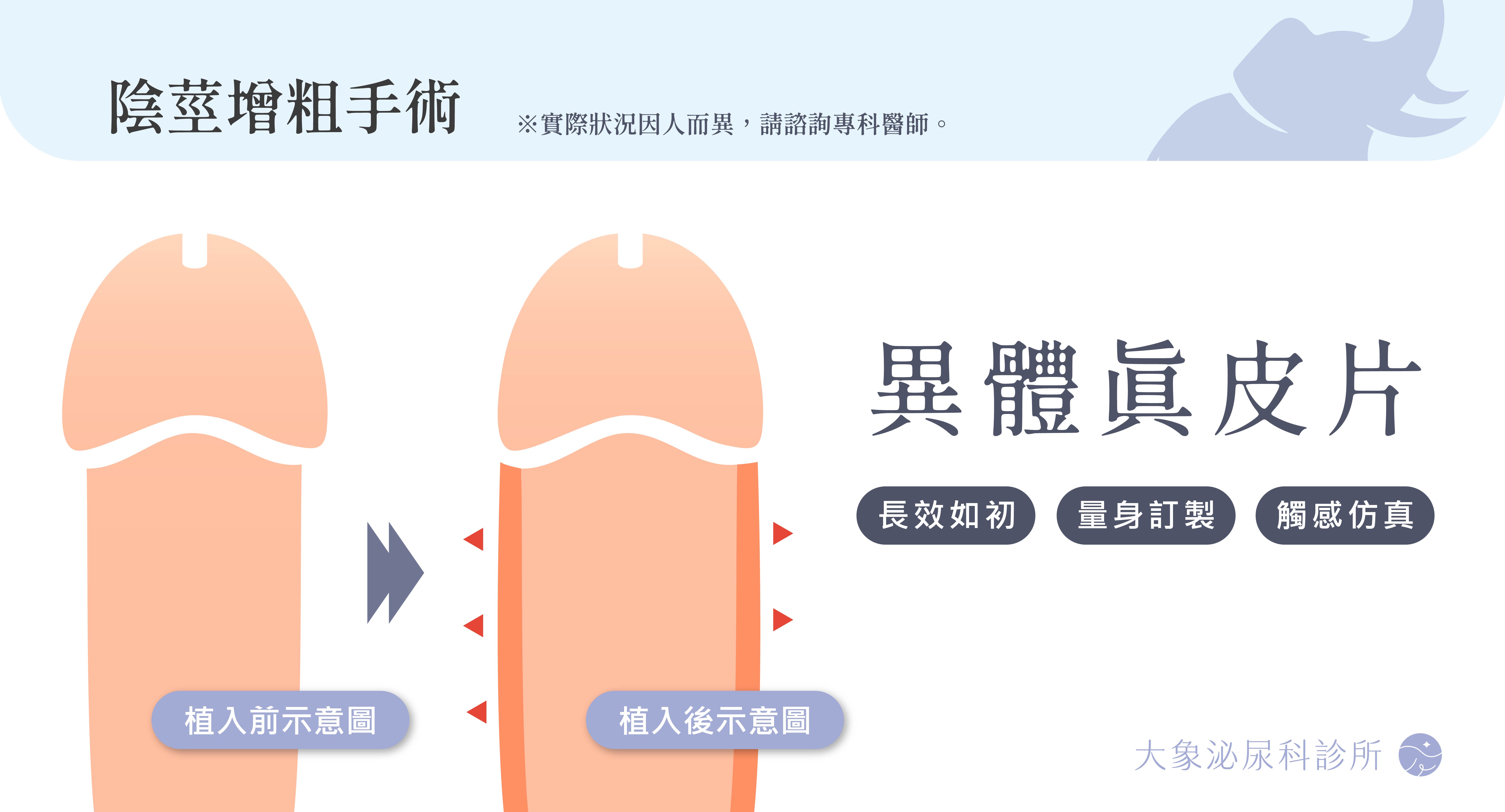 陰莖增粗