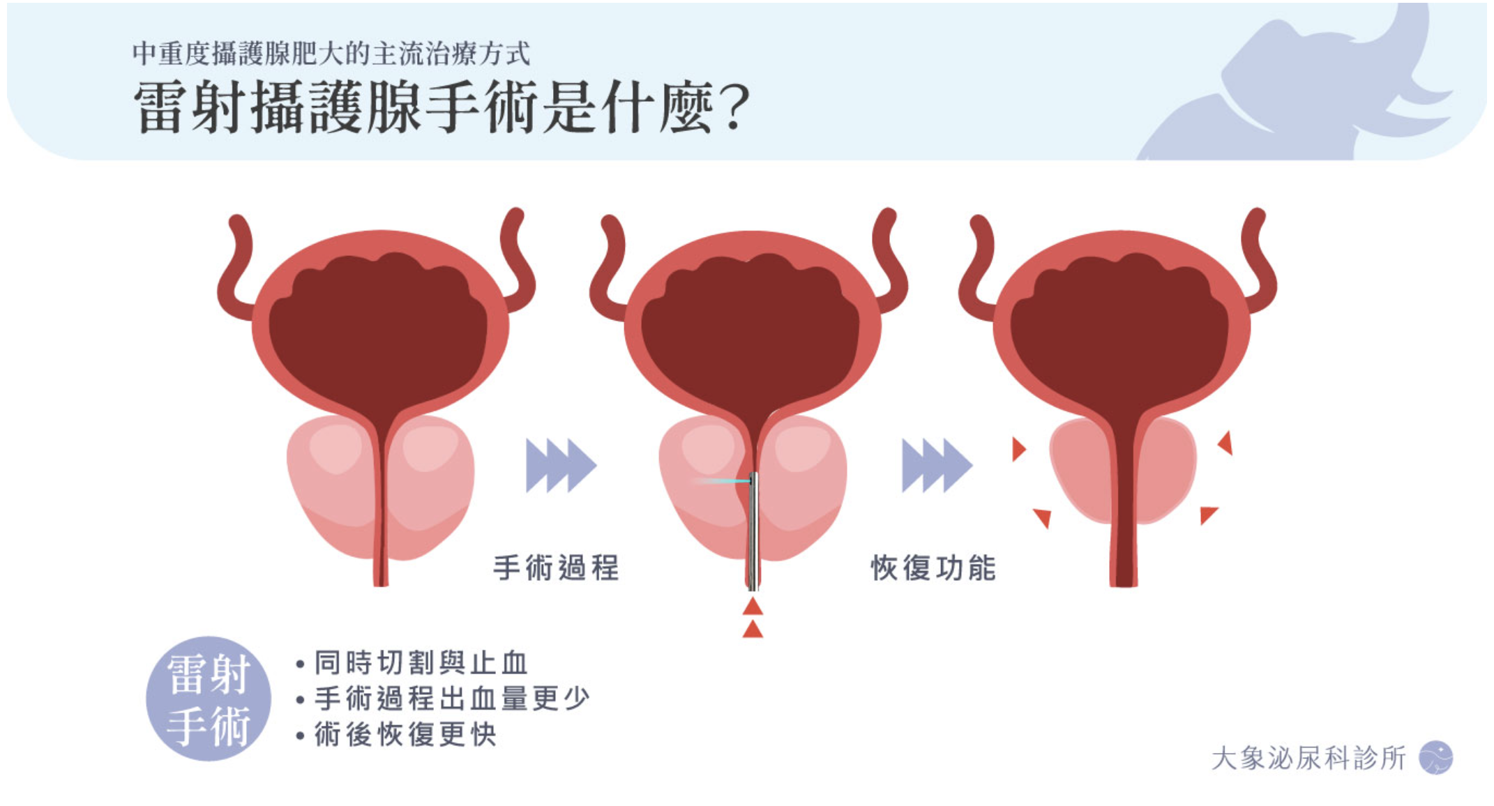 桃園 中壢/泌尿科/大象 - 雷射攝護腺手術完整解析：安全性、費用、恢復期與性功能影響
