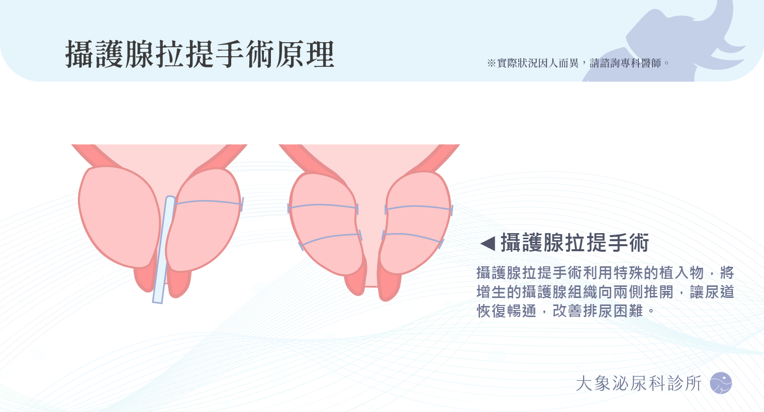 攝護腺拉提手術