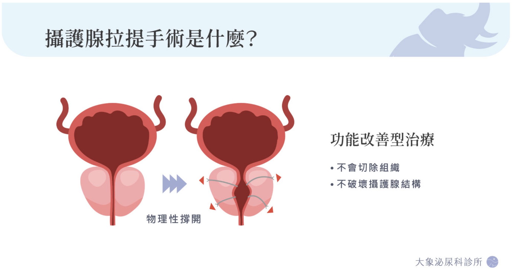 桃園 中壢/泌尿科/大象 - 攝護腺拉提手術完整解析：有效嗎？與雷射手術差異、恢復期與性功能影響